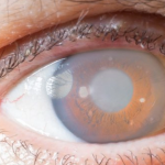 GLAUCOMA