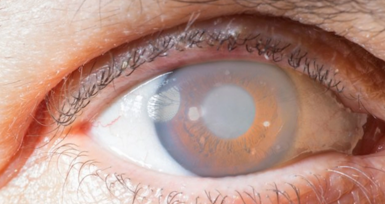 GLAUCOMA