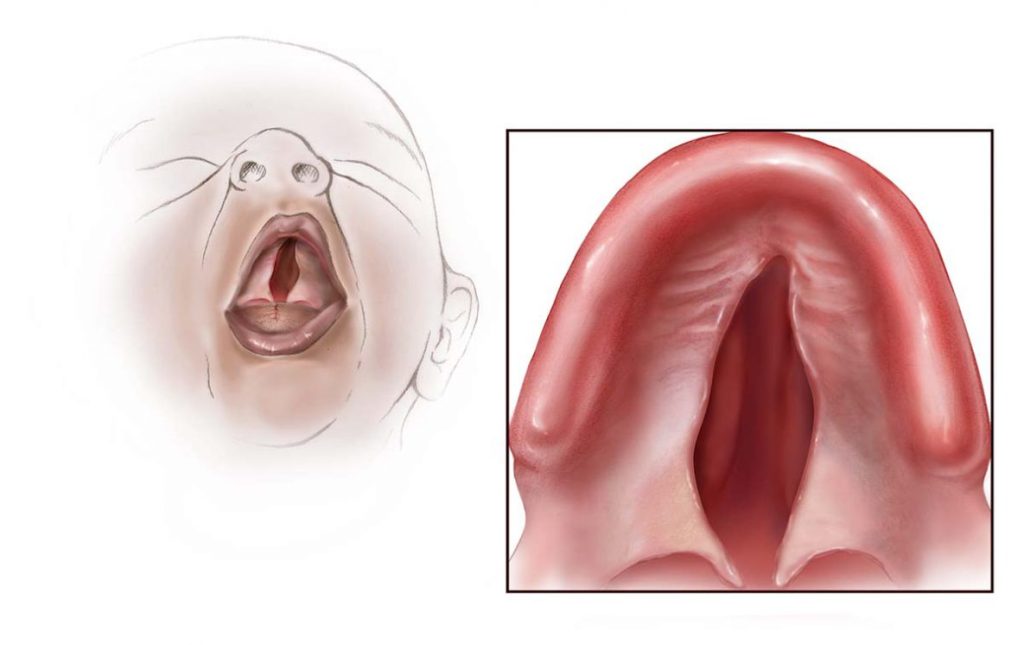cleft palate