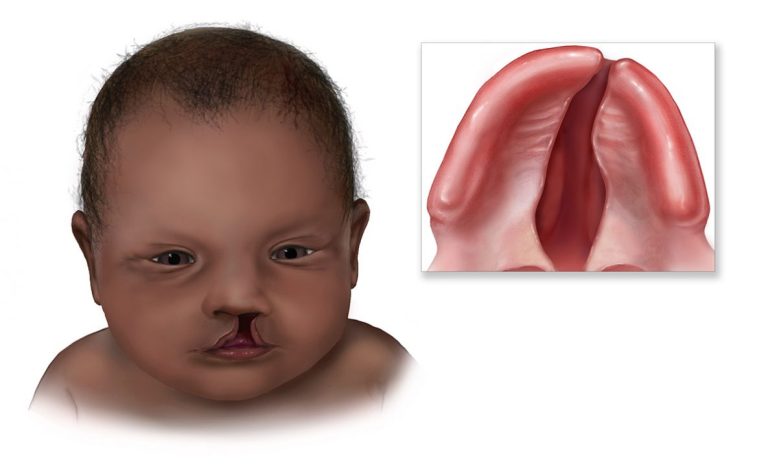 cleft-lip-palate