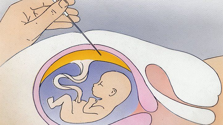 Amniocentesis
