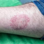 Lyme disease