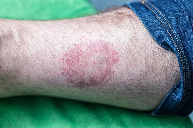 Lyme disease